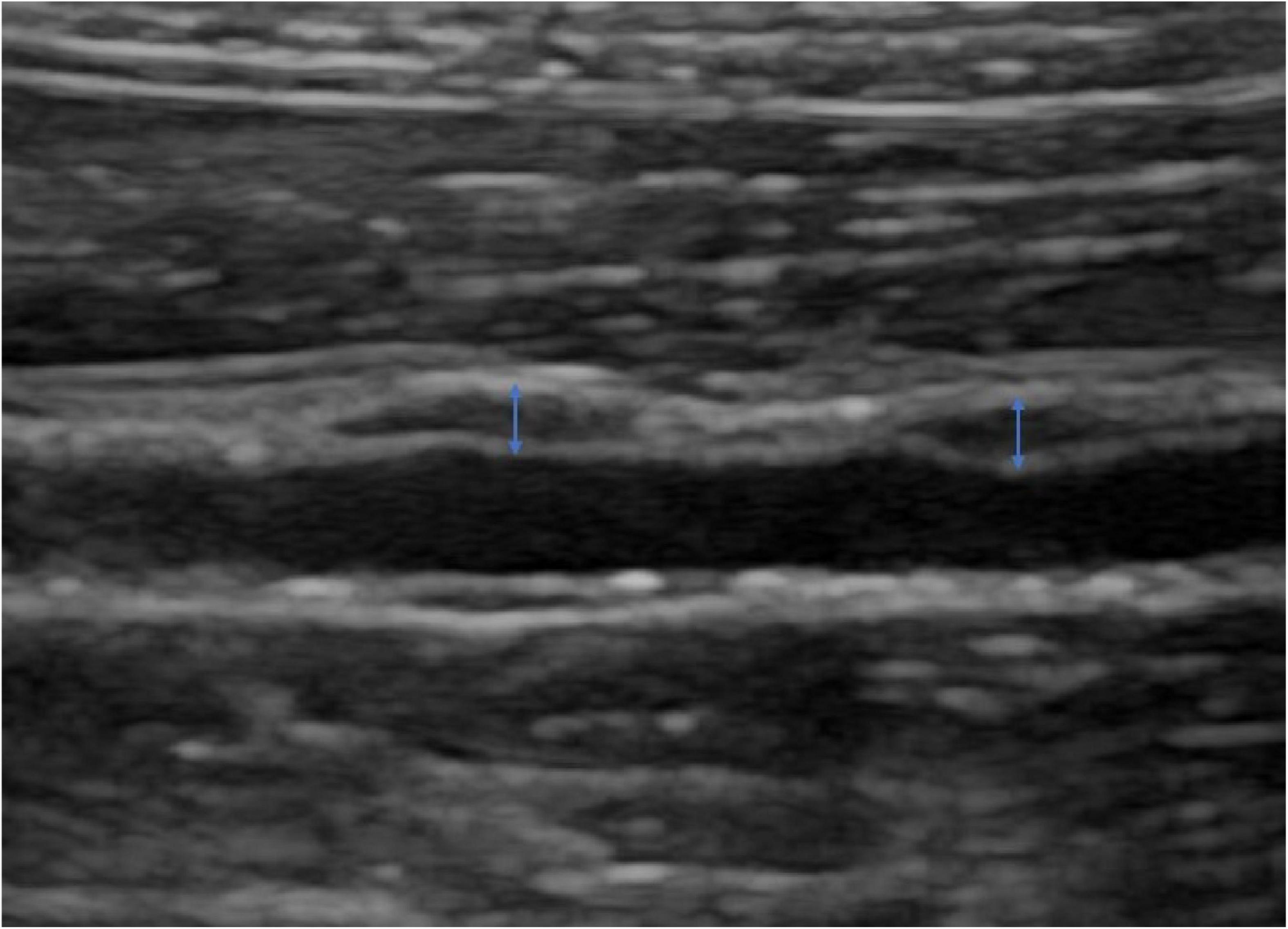 Effects of norepinephrine on plaque hypoxia in atherosclerotic rabbits